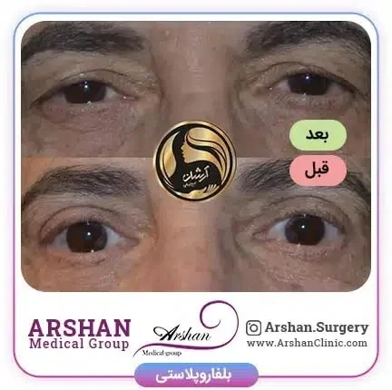 جراحی پلک چیست و چند نوع است؟