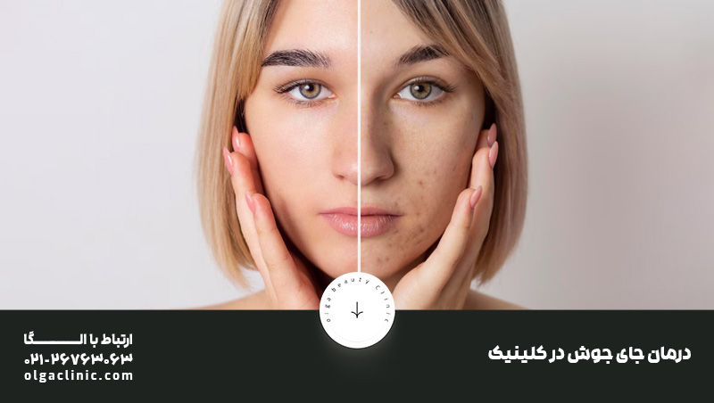 درمان های سریع از بین بردن جای جوش در کلینیک