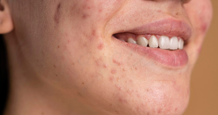 از بین بردن لکه های قهوه ای جای جوش در سریع ترین زمان