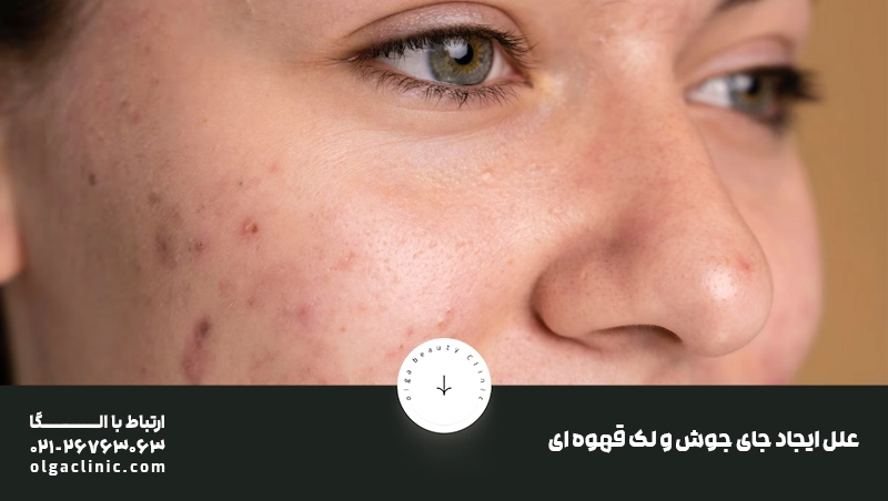 علل ایجاد جای جوش و لک قهوه ای آن